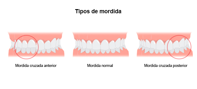 mordida cruzada