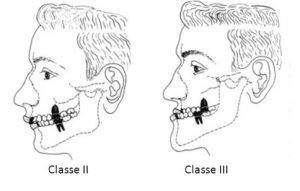 Invisalign - Ortodontia
