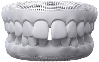 ArtDente Beltrão - ➡ Conheça o Invisalign, o aparelho invisível que está  na boca dos famosos! 😁 ✓ Transforme o seu sorriso, com a gente!😊 🔹  Agende sua consulta! 😉 Artdente Odontologia